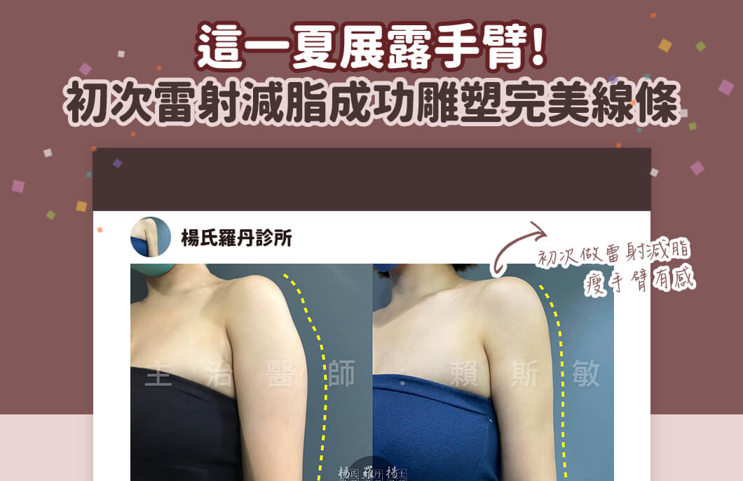 【雷射減脂】這一夏展露手臂!初次雷射減脂成功雕塑完美線條
