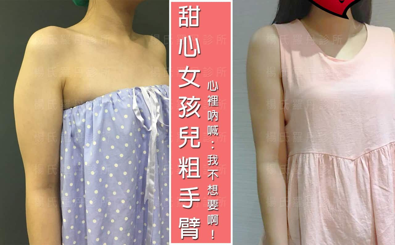 【雷射減脂】甜心女孩兒怎麼可以有粗手臂！