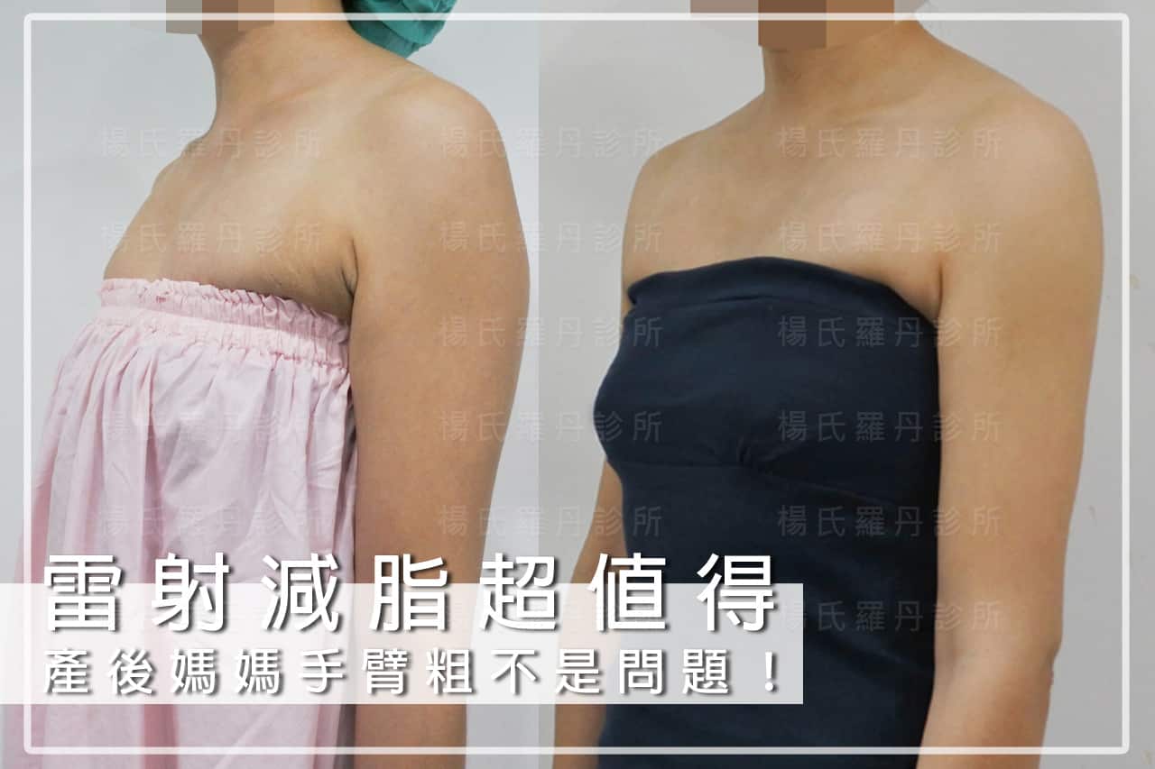 【雷射減脂】夏天就是要露出細手臂！