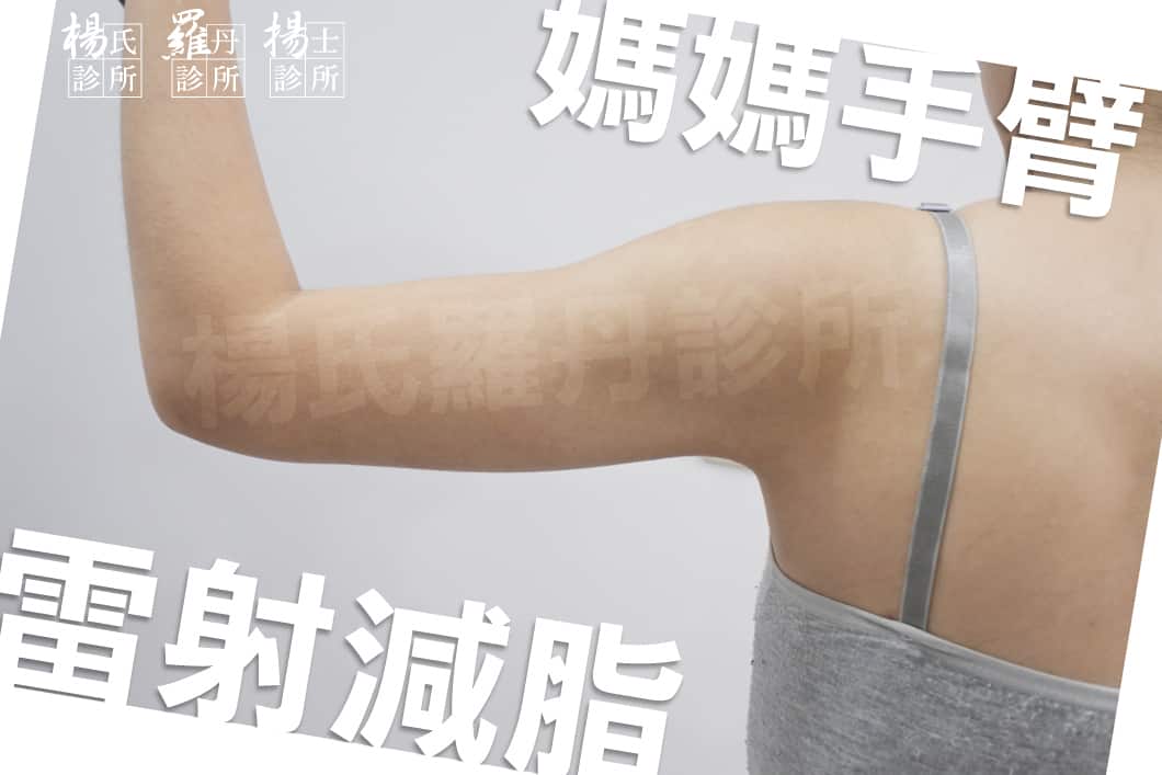 【雷射減脂】拯救我的媽媽手臂！