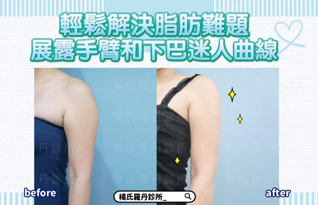 【雷射減脂】輕鬆解決脂肪難題，展露手臂和下巴迷人曲線