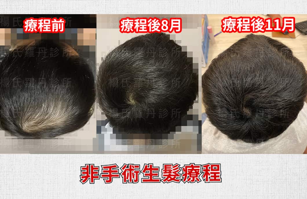 診友進行複合式生髮療程，8個月和11個月的對比照，頂部頭髮越來越濃密
