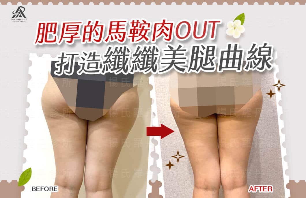 【雷射減脂】肥厚的馬鞍肉OUT！打造纖纖美腿曲線！