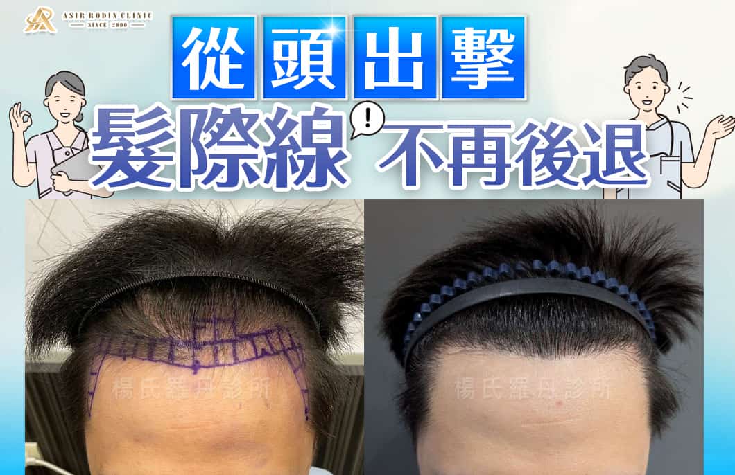 【植髮】專業助你從頭出擊，讓髮際線不再後退自然歸位