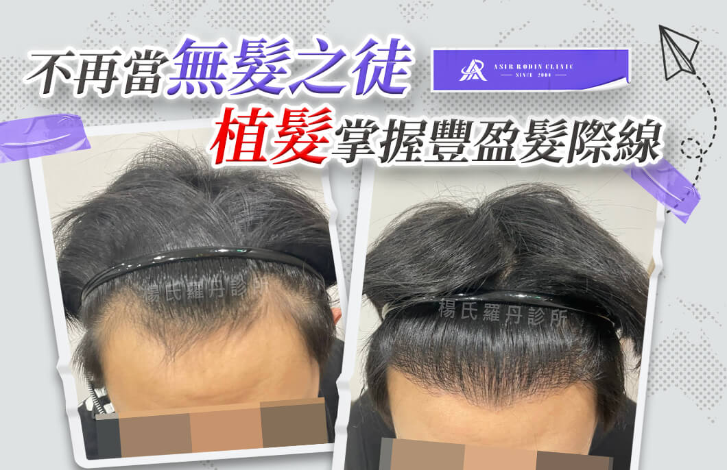 【植髮】對抗禿頭不再當無髮之徒，植髮掌握豐盈髮際線