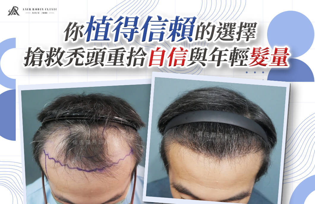 【植髮】你植得信賴的選擇，搶救禿頭重拾自信與年輕髮量