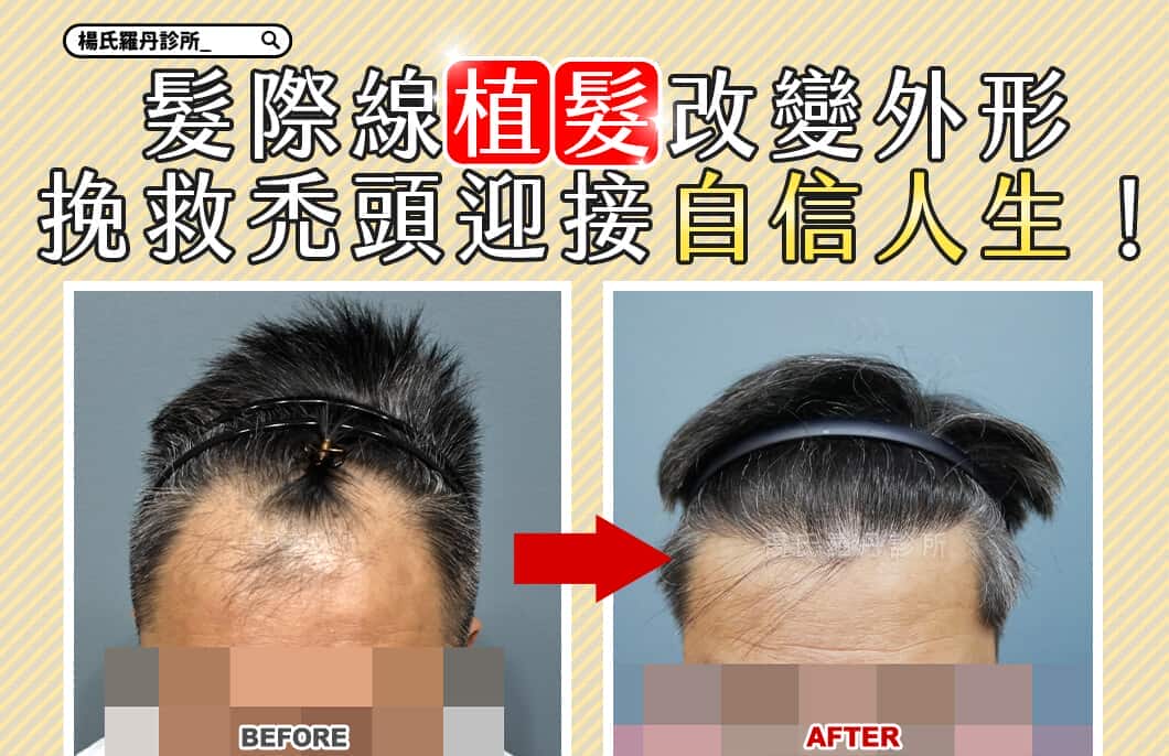 【植髮】髮際線植髮改變外形，挽救禿頭迎接自信人生！