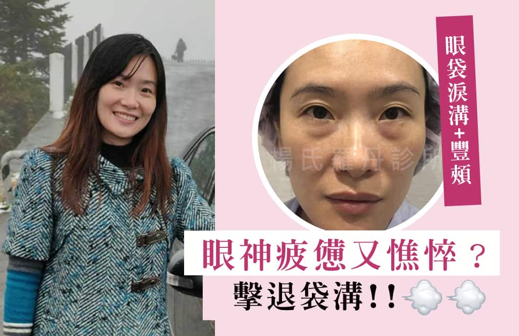 【眼袋淚溝+豐頰】眼神疲憊又憔悴？擊退袋溝!!