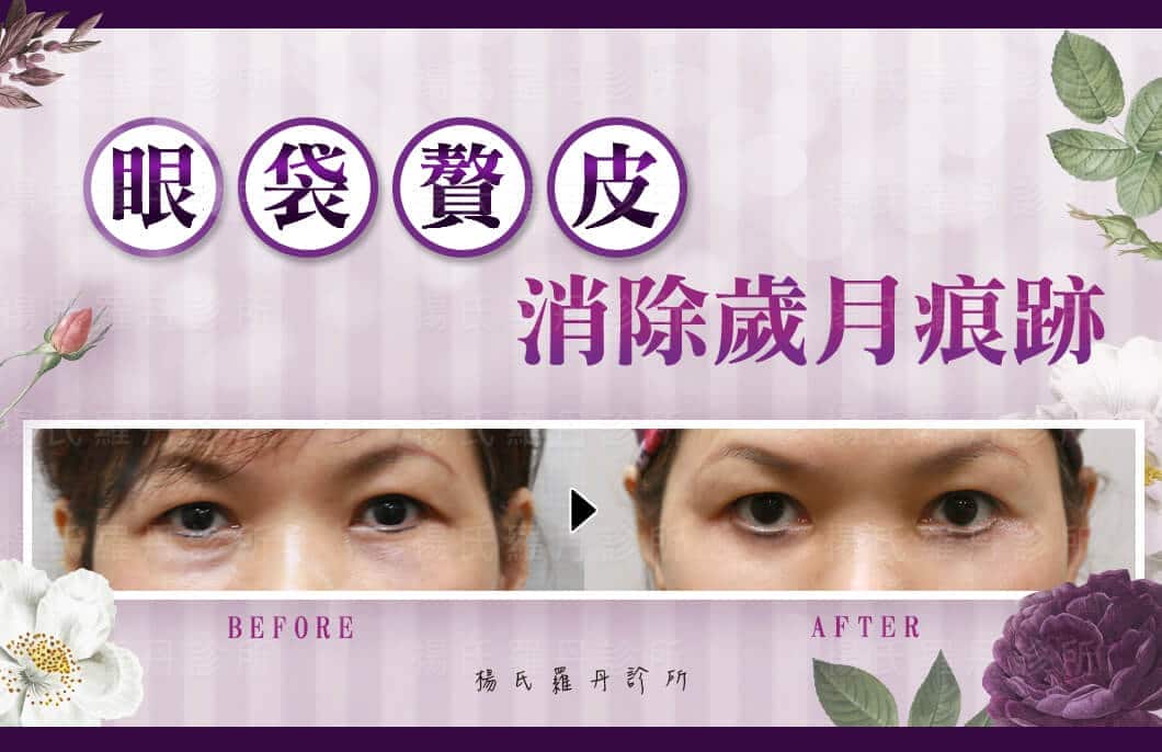 【眼袋淚溝】眼袋+贅皮消除歲月痕跡 擁有好氣色不顯老